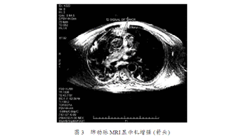 吸气性呼吸困难