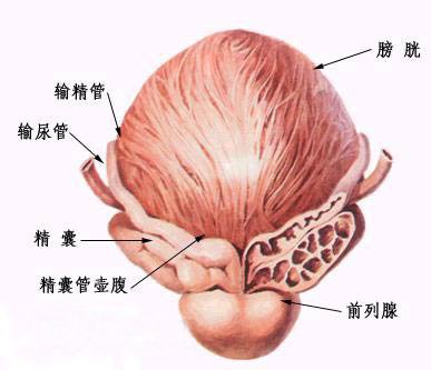 前列腺钙化灶