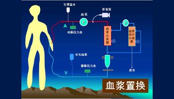 血浆置换治疗示意图