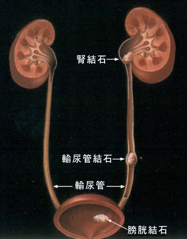 肾结石示意图图片